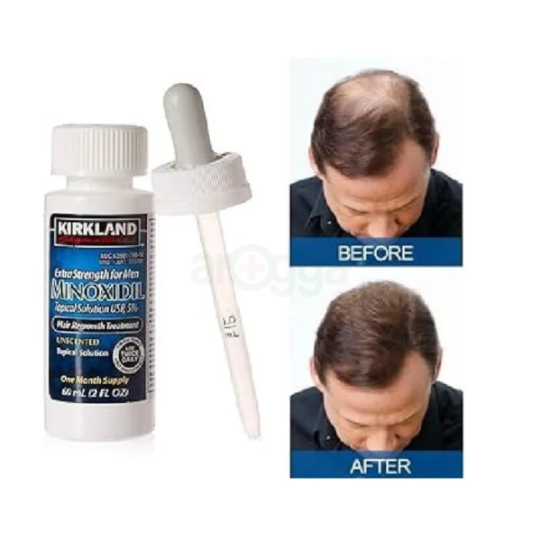 Kirkland 5% Minoxidil Extra Strength Hair Loss & Hair Regrowth Treatment